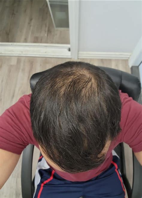 hermest hair transplant yorumları|hermest hair transplant reviews reddit.